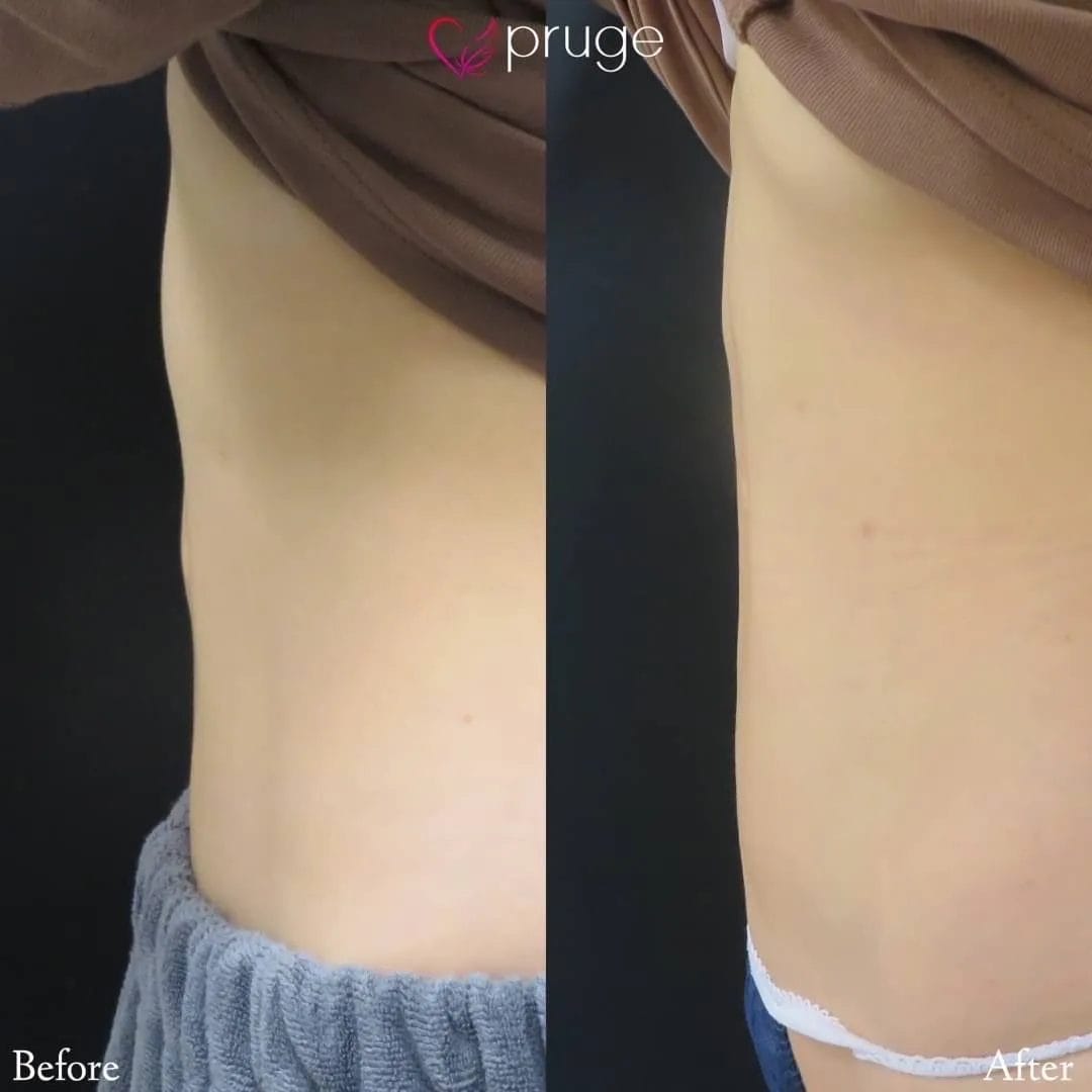 脂肪吸引後修正MAX（お腹）