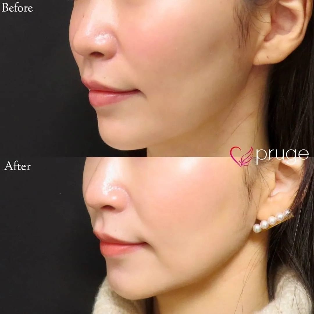 PRP注射（ホホ）