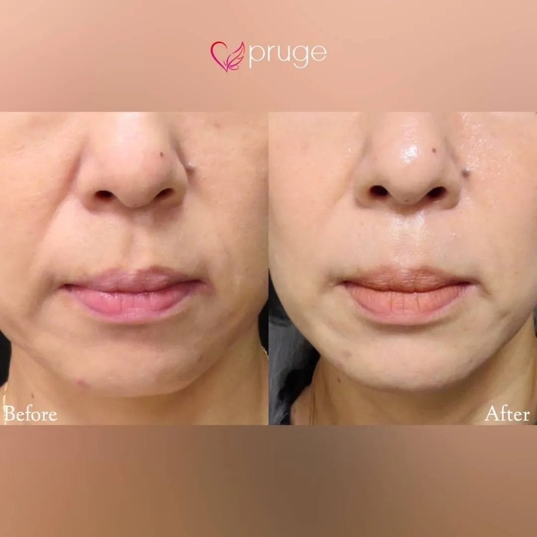 PRP注射（ほうれい線）