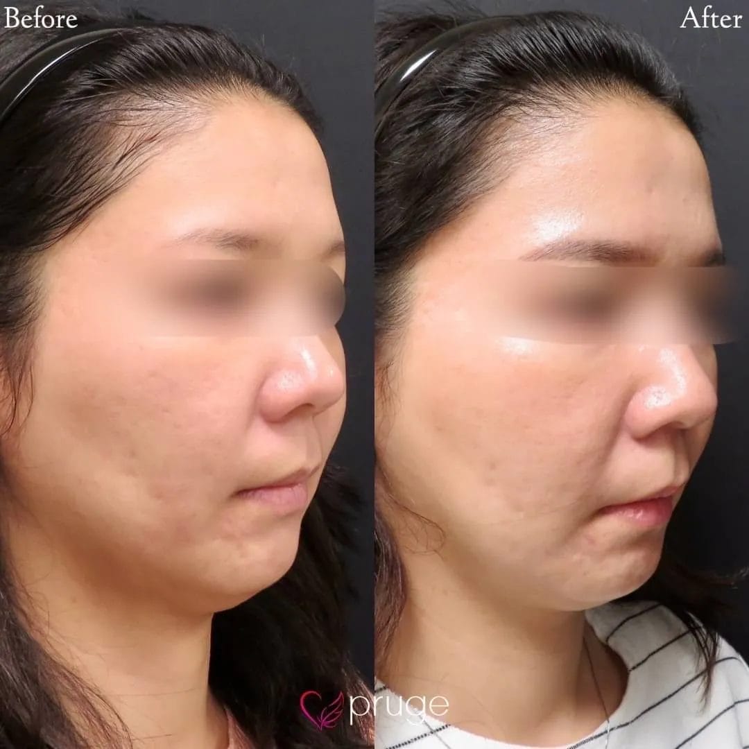 ヴァンパイアフェイシャル（全顔）