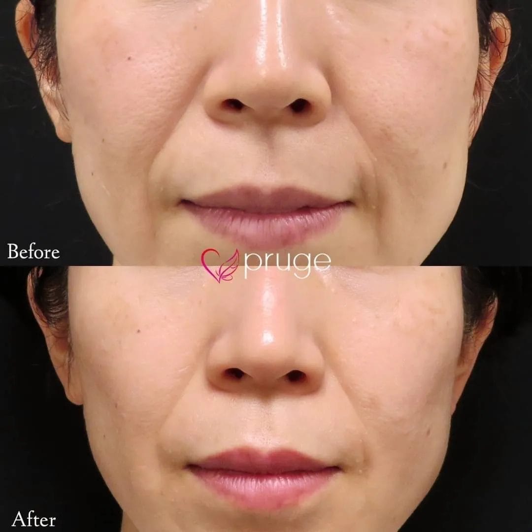 PRPコラーゲンリフト（ほうれい線）40本