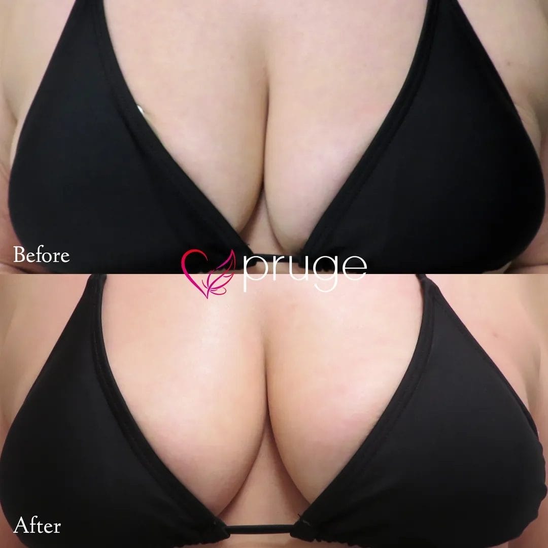 PRP注射（お胸）