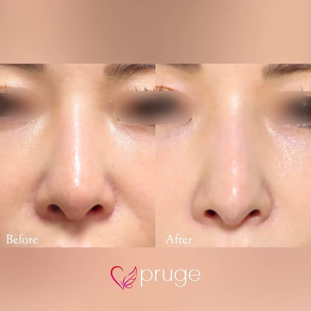 PRP注射（鼻尖）