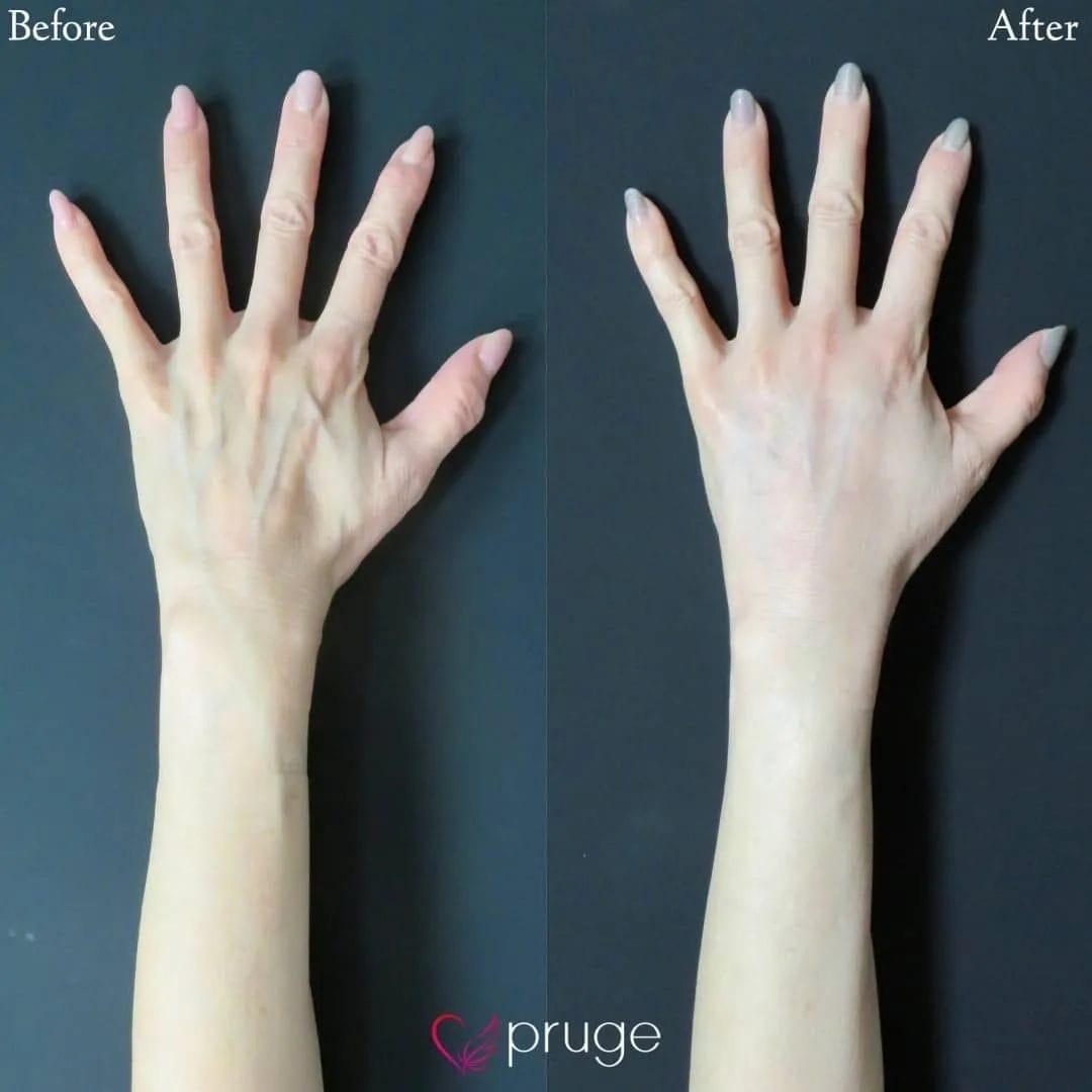 PRP注射（手の甲）