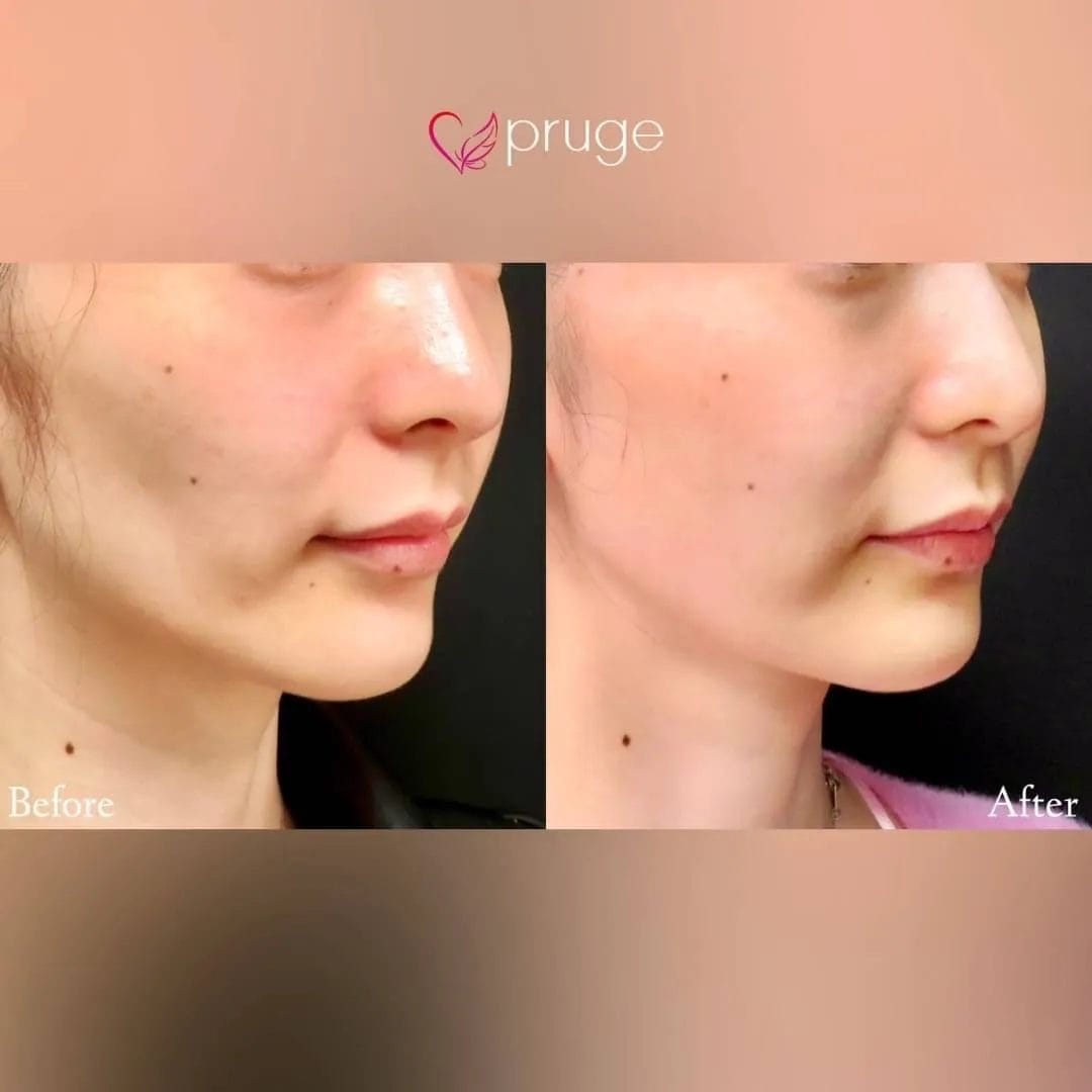 PRP注射（ホホ）