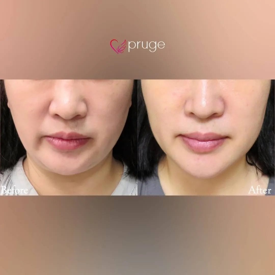 PRP注射（ほうれい線）・pスリム注射（フェイスライン）