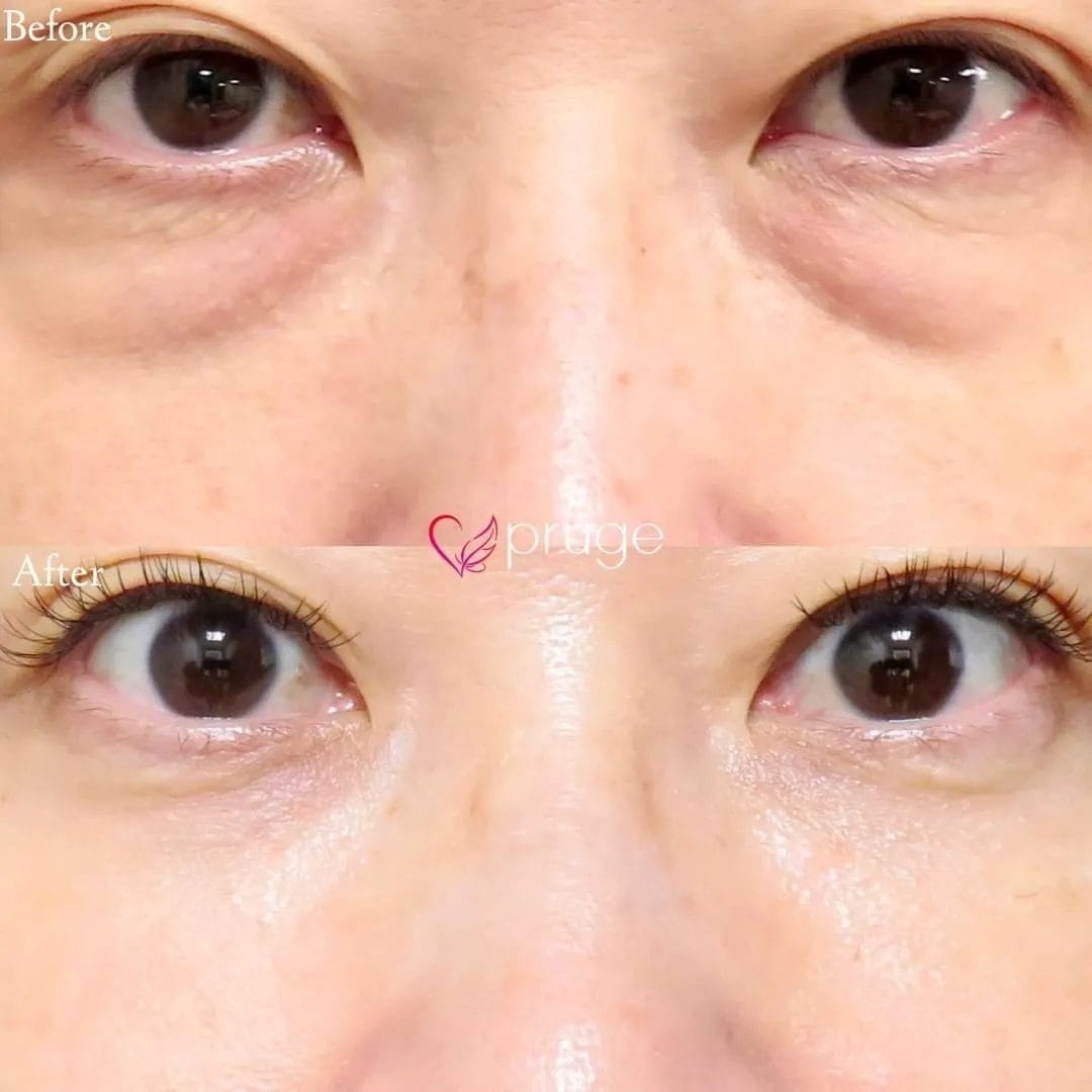 PRP-MI脱脂術(目の下)