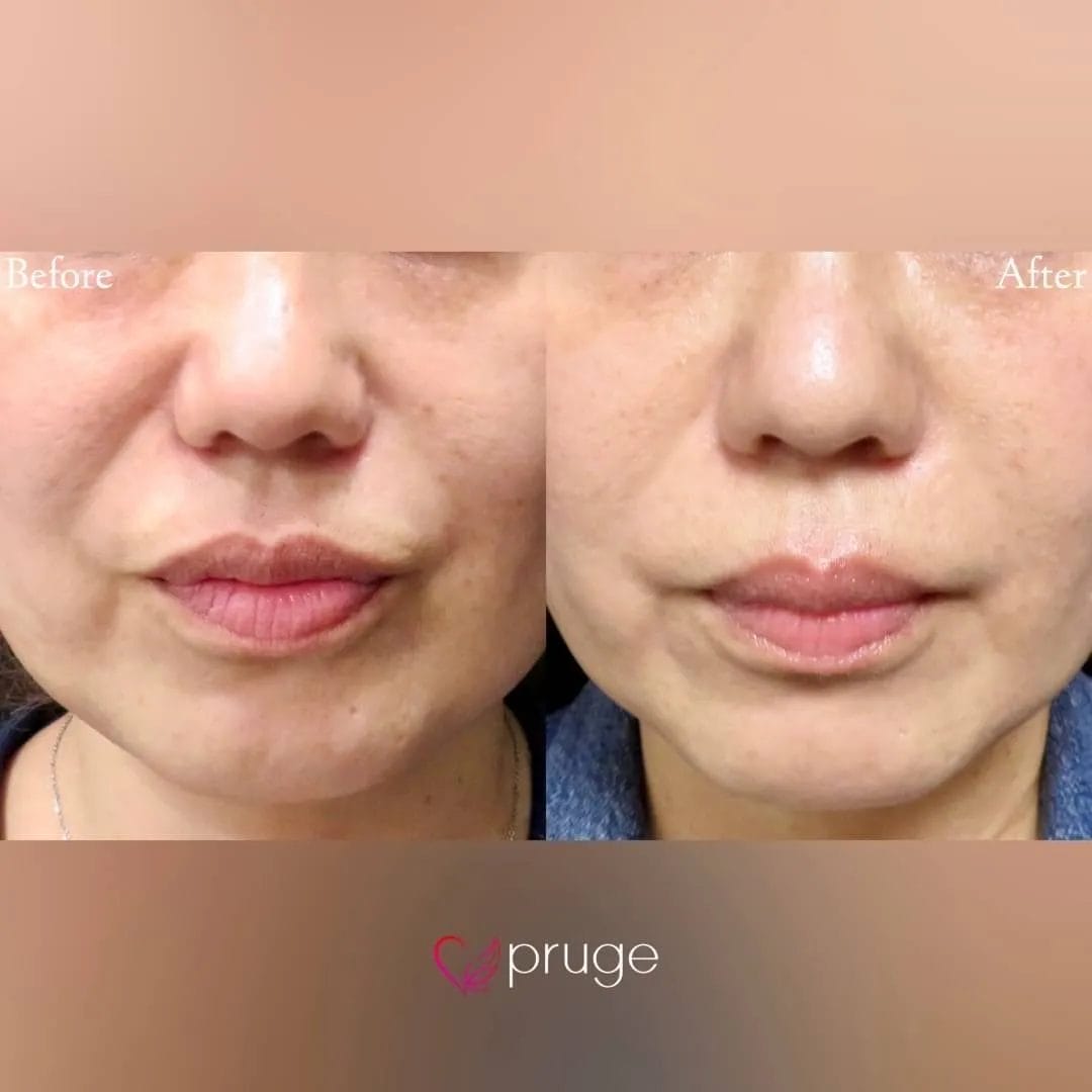 PRP注射（ほうれい線）