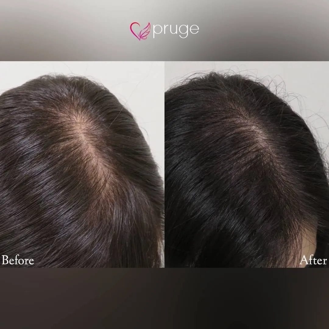 ｐ-スカルプ（1回）