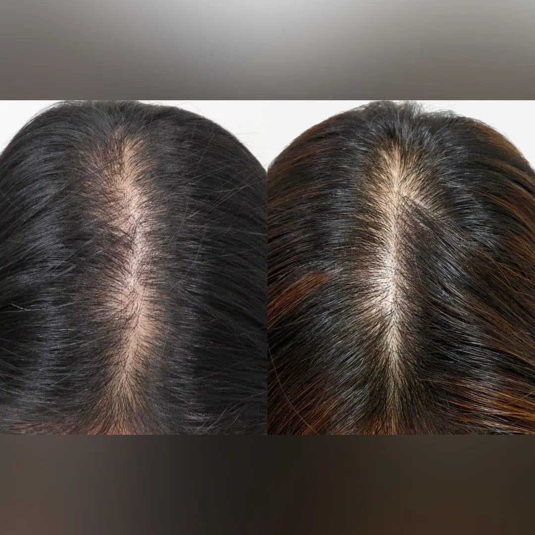 ｐ-スカルプ（3回）