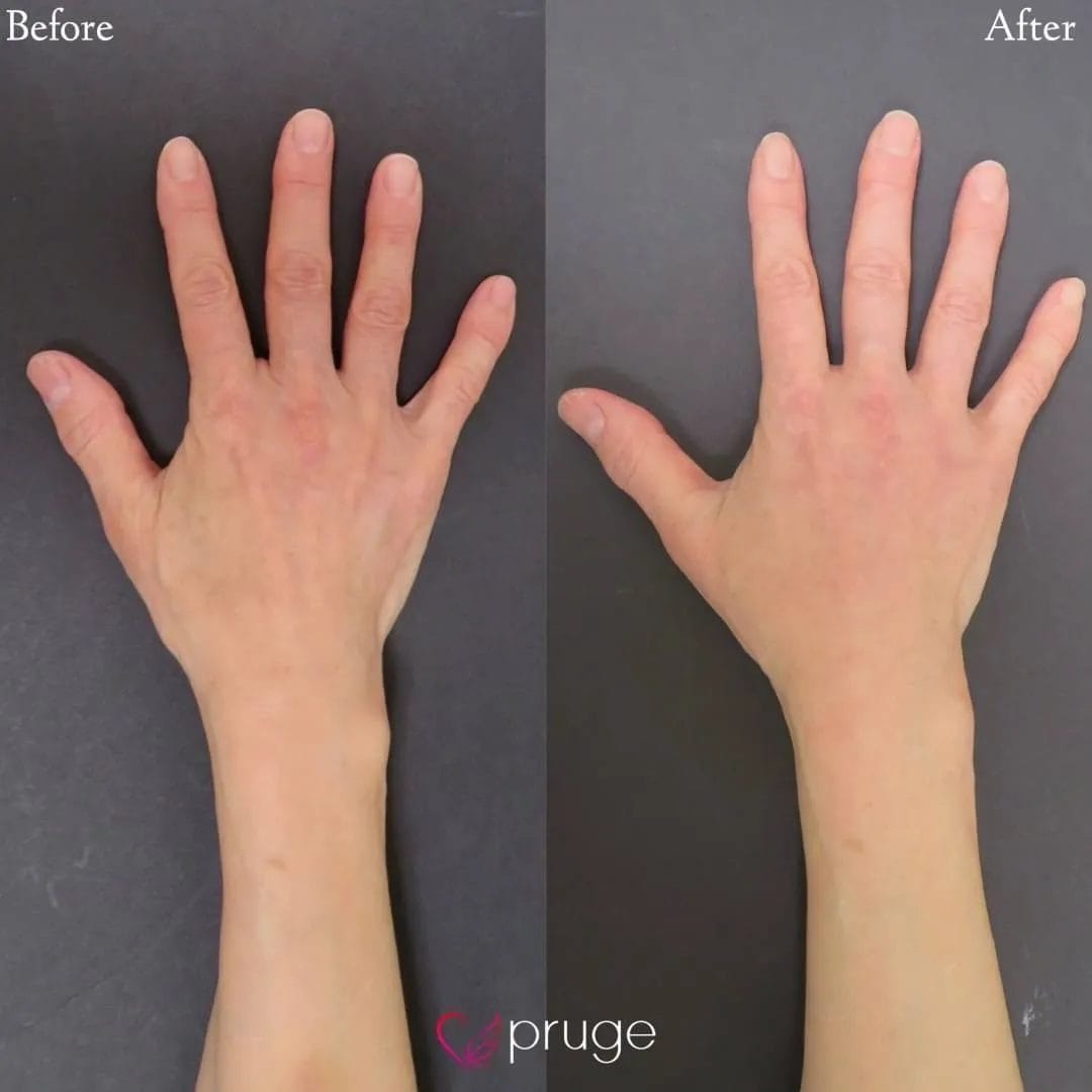 PRP注射（手の甲）