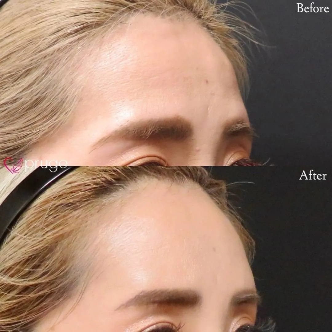 PRP注射(ひたい・こめかみ丸み形成)