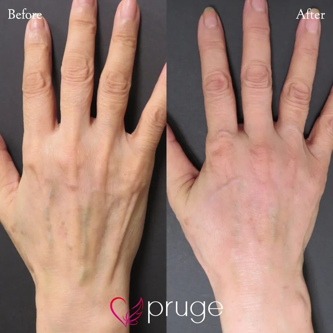 手の甲のスジ・血管