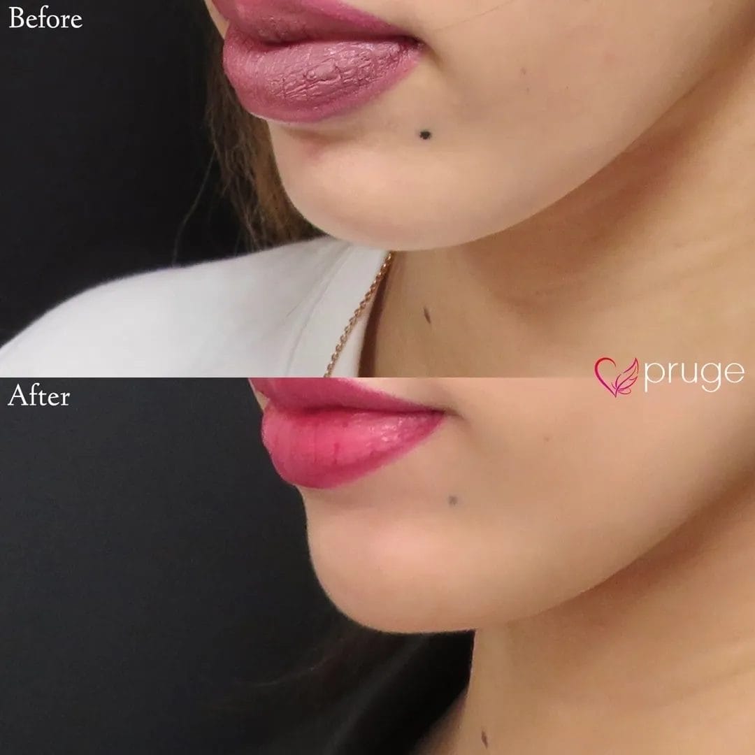 PRP注射（アゴ）