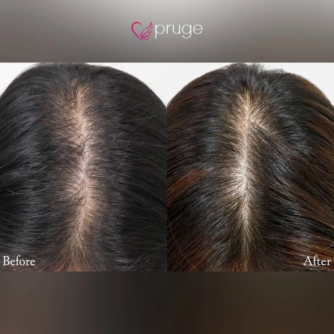 ｐ-スカルプ（3回）