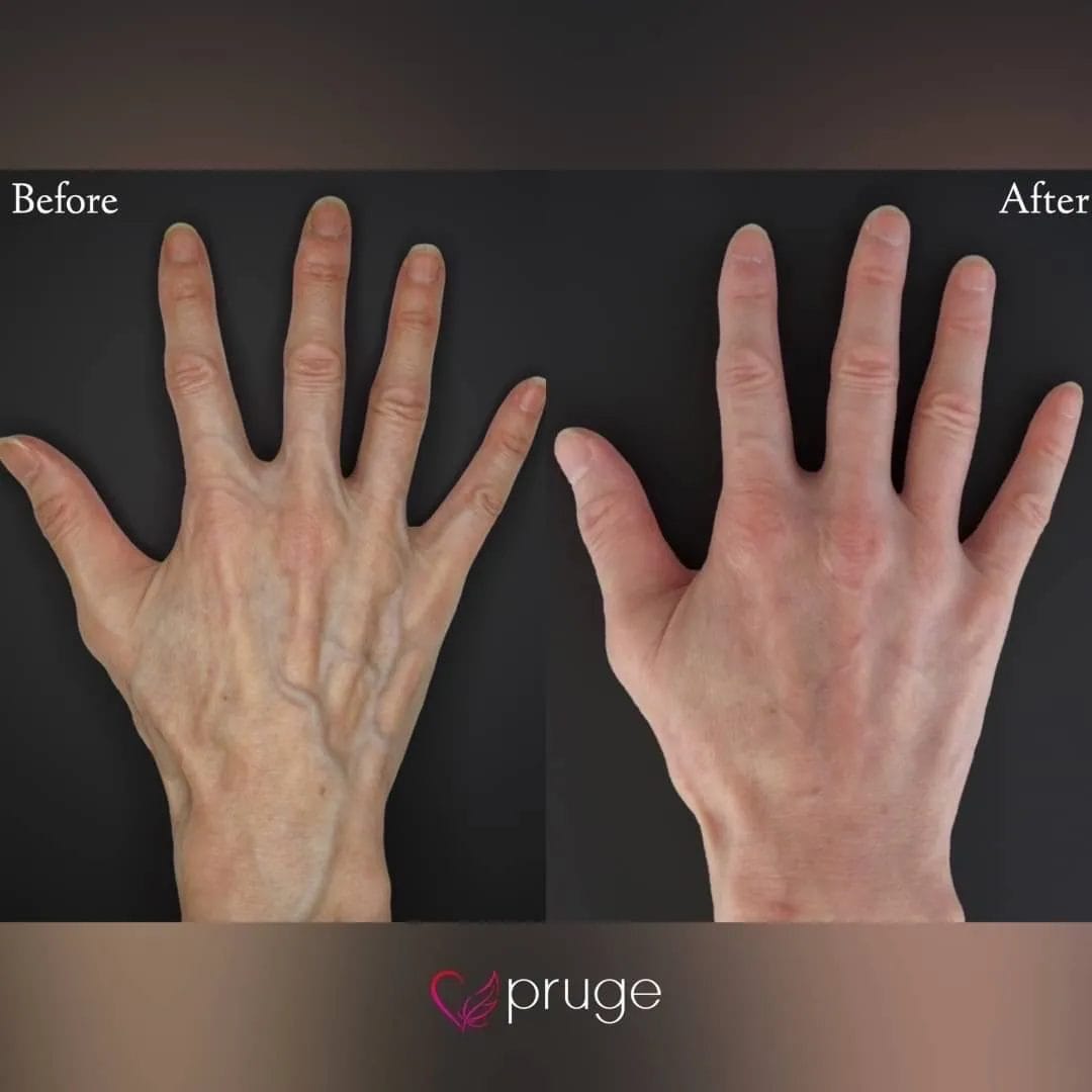 ハンドベイン（レーザー療法）