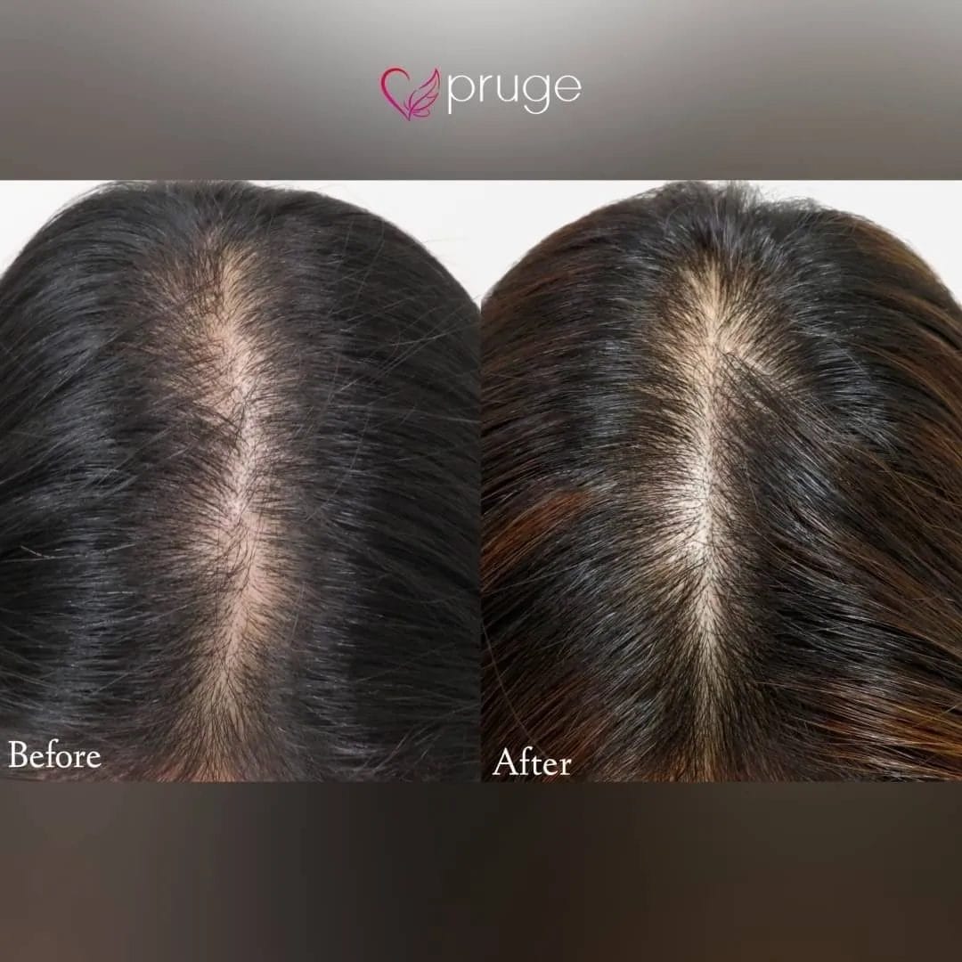 ｐ-スカルプ（3回）