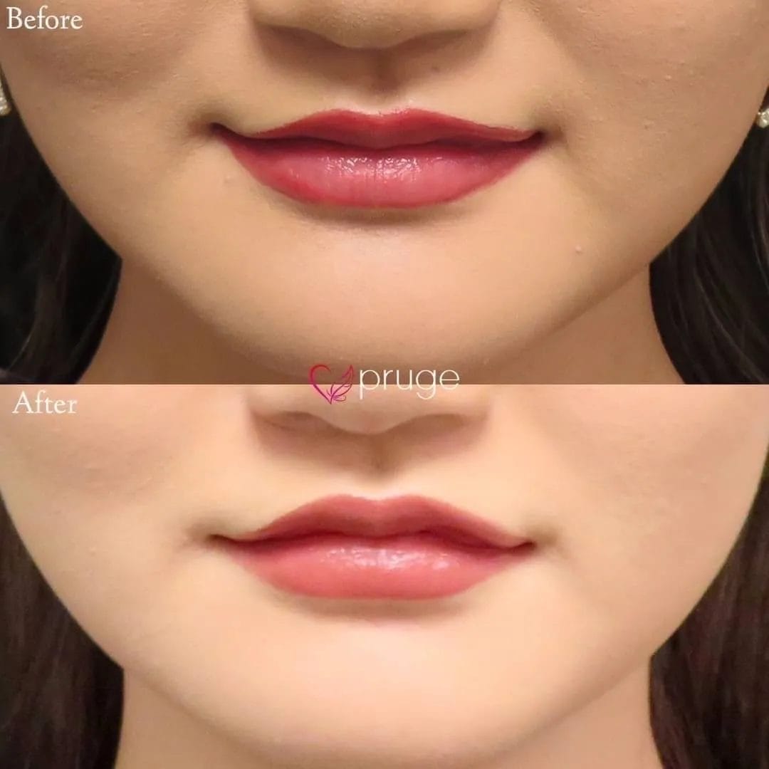 PRP注射（くちびる）