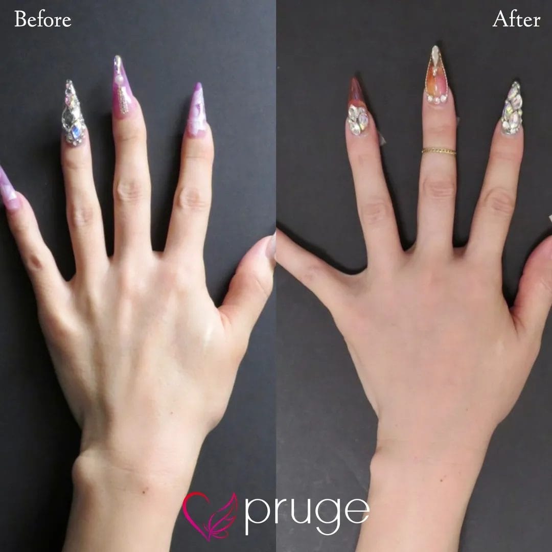 手の甲のスジ・乾燥