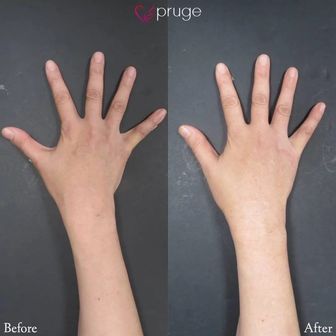 PRP注射（手の甲）