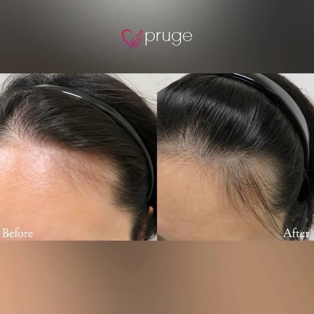 ｐ-スカルプ（1回）