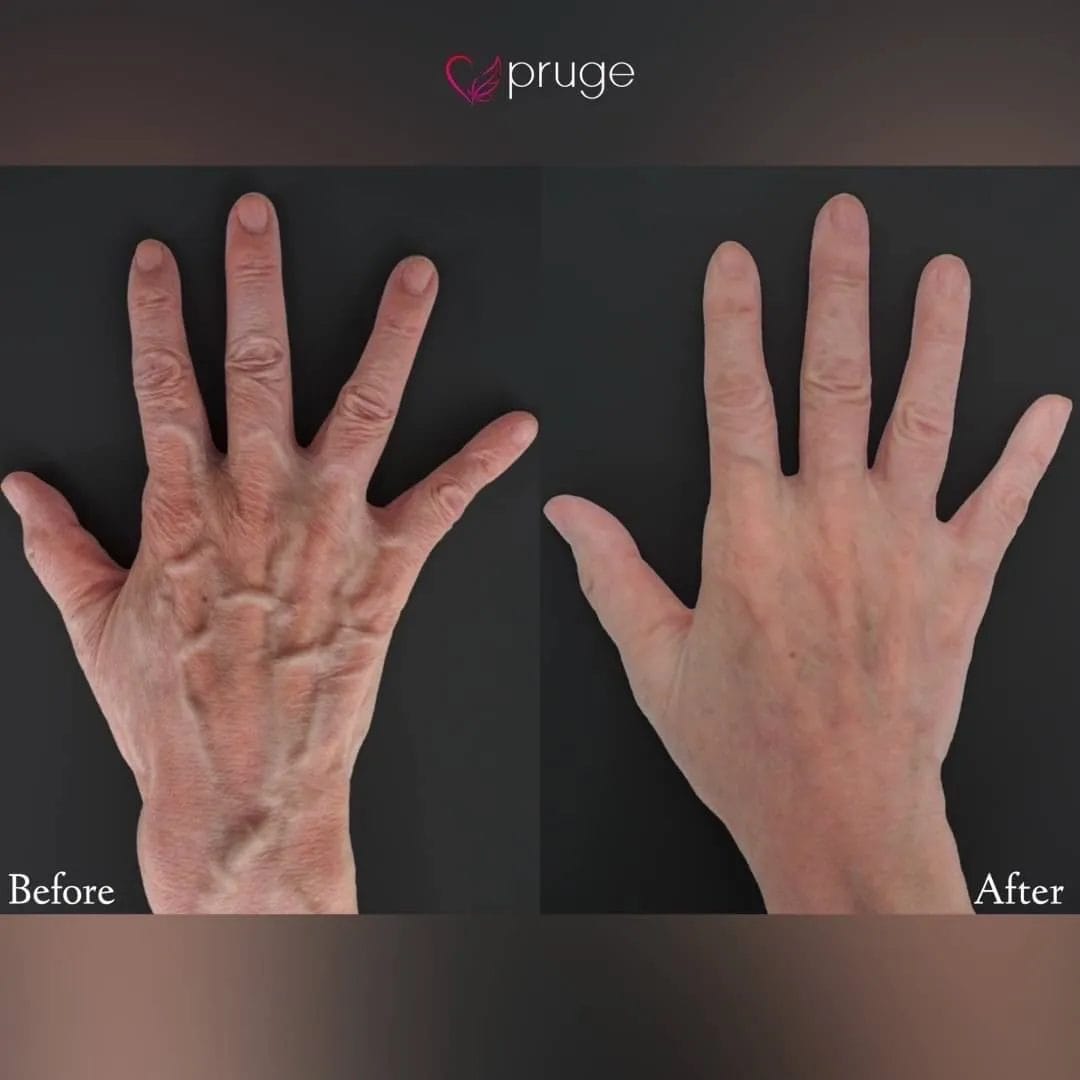 ハンドベイン（レーザー療法）