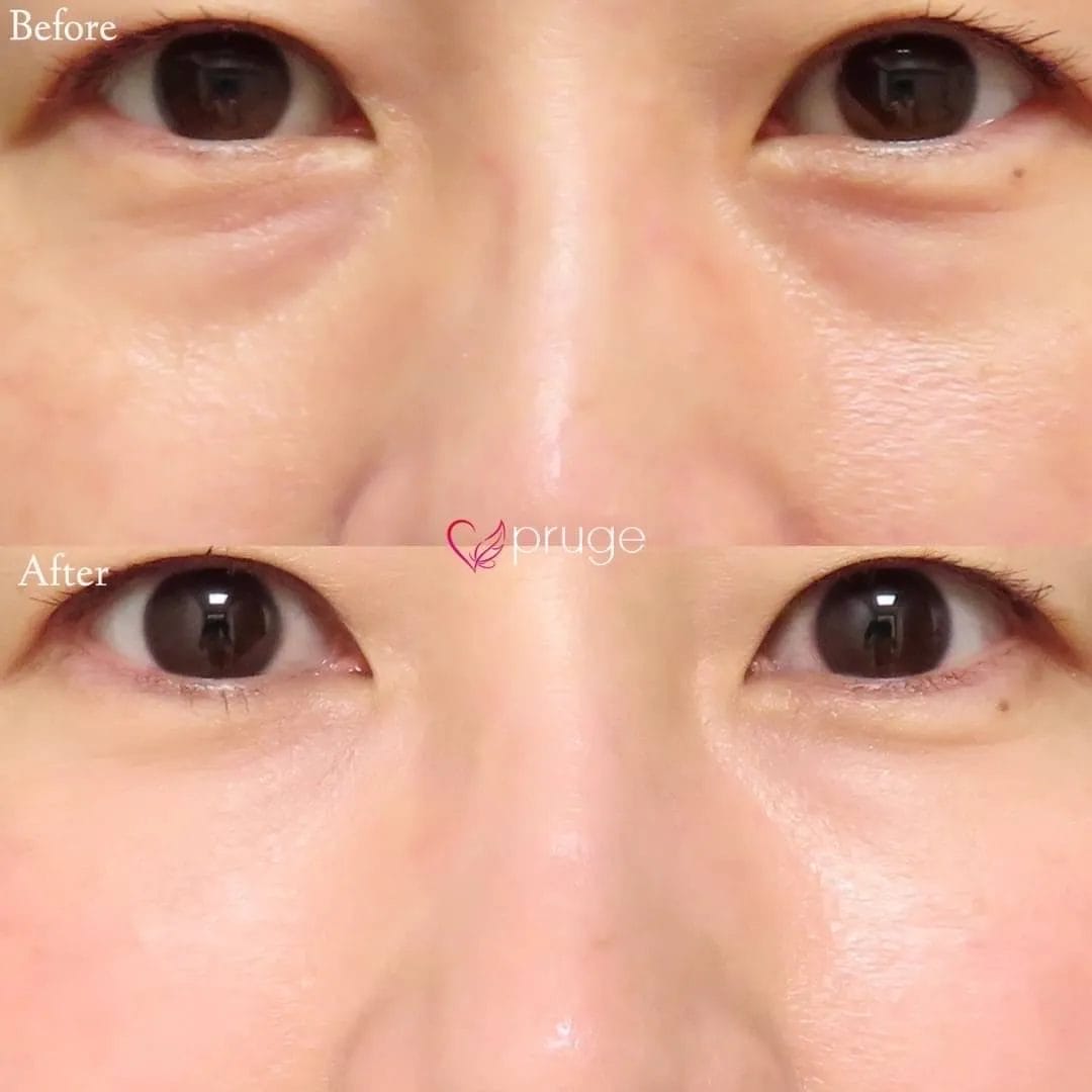 PRP注射アイスプレミアムは、フリーズドライ化する事により成長因子の濃度が通常のPRP注射の2倍以上含まれる為、より高い効果をご実感いただけます。