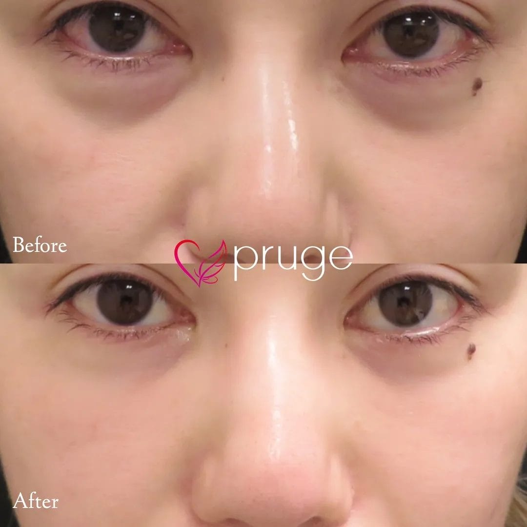 経結膜脱脂術で脂肪を取り除き、ご自身の血液から抽出したPRPを、皮下組織に注入し、組織の修復効果が得られることで、症状が改善します。