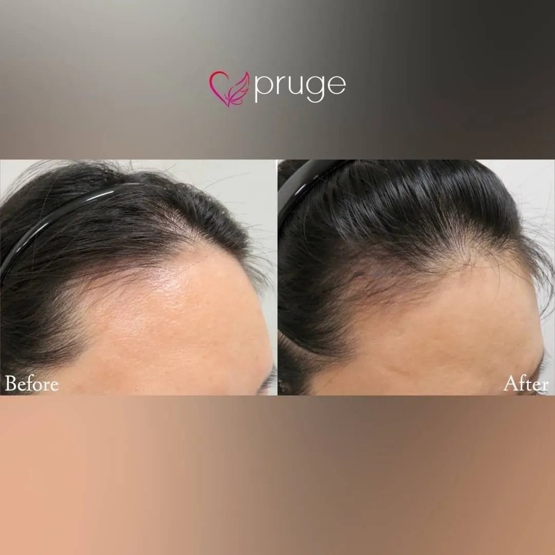 ｐ-スカルプ（1回）