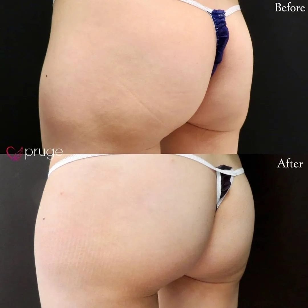 PRP注射によるヒップ形成