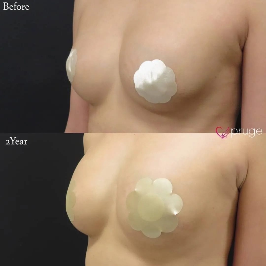 PRP注射によるシリコンバッグ豊胸修正