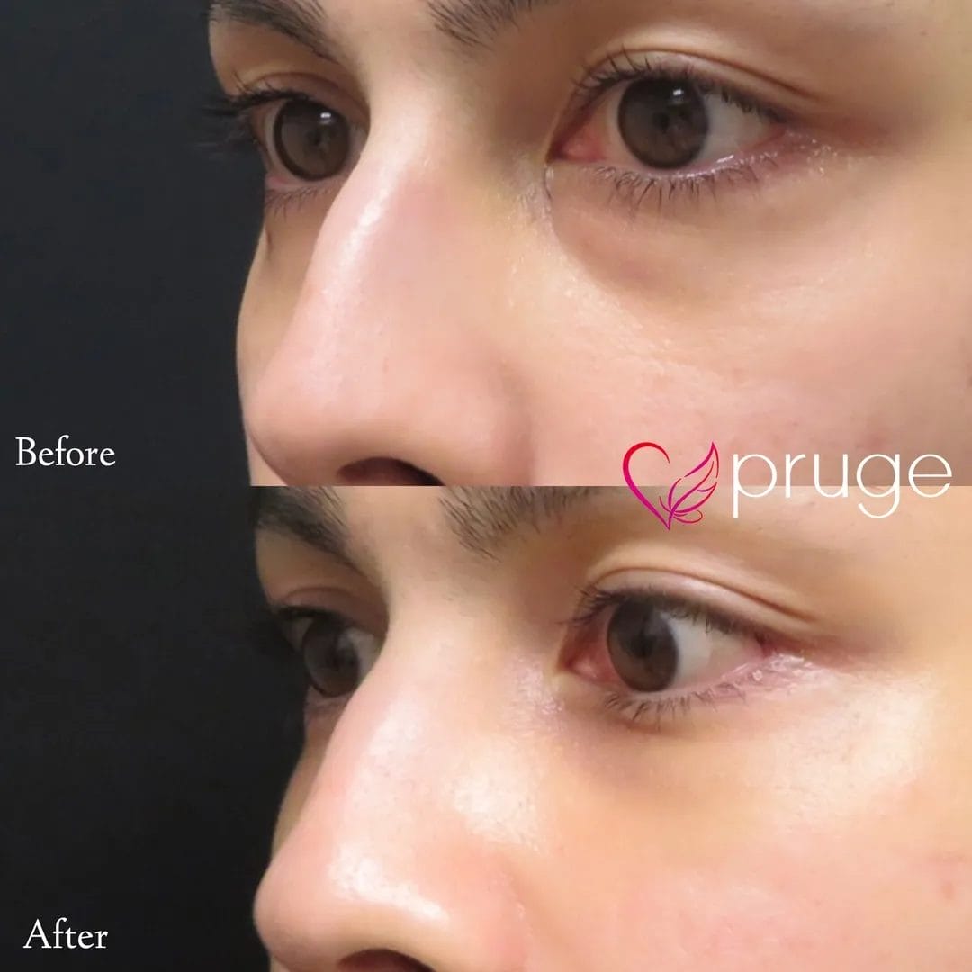 目の下のクマ・凹み