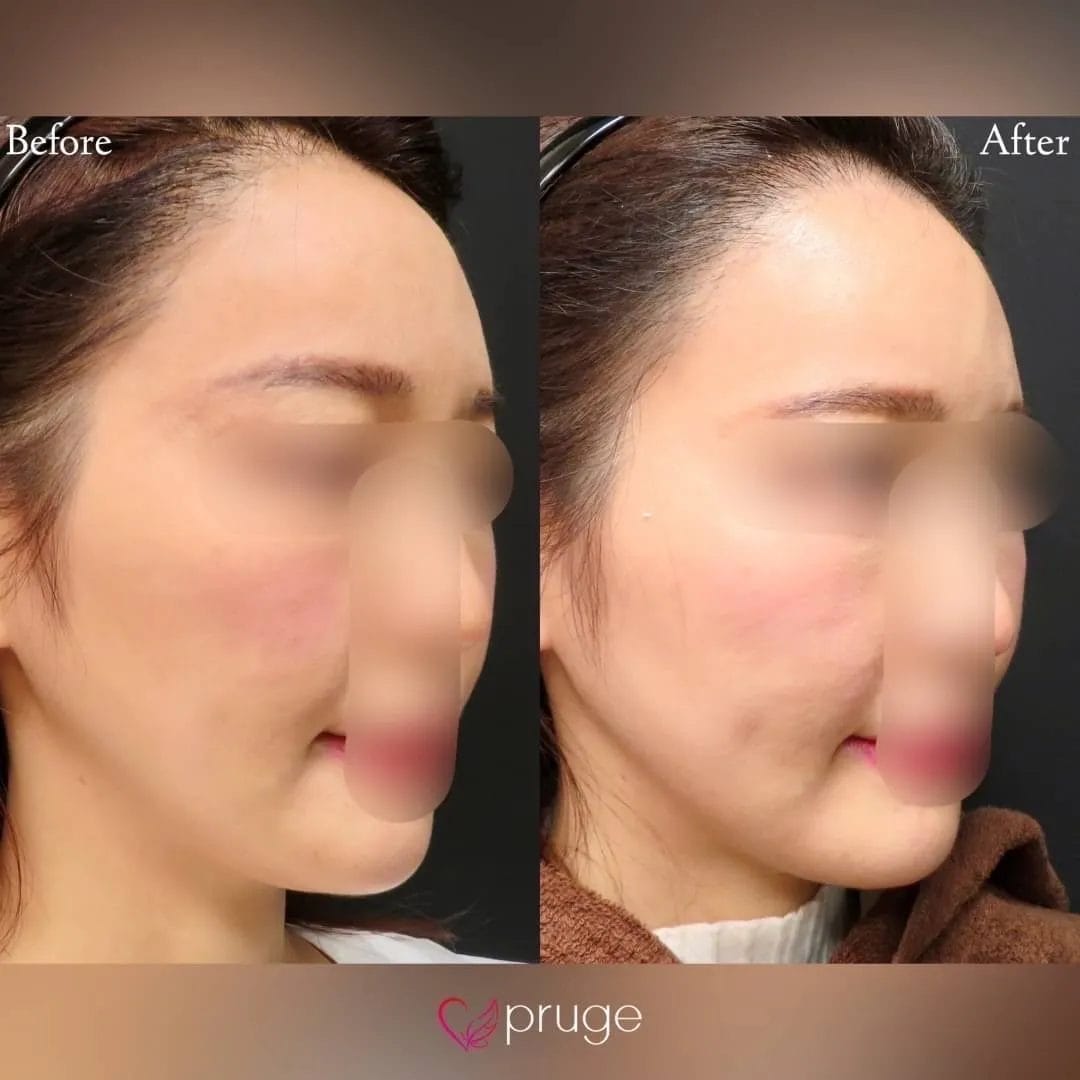 ダイエットでは落ちにくいお顔の脂肪…