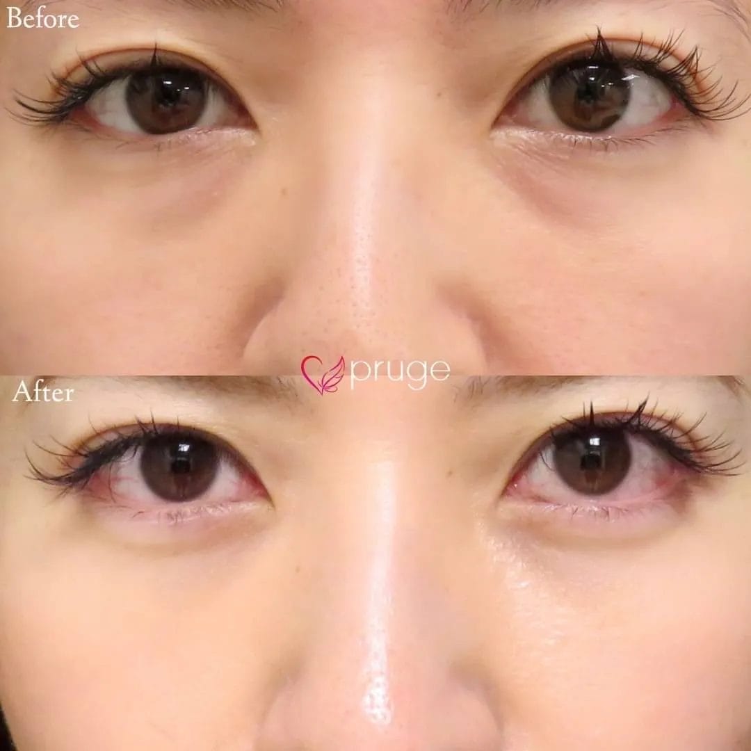 お写真の患者様は、膨らみが影のようになってしまい表情が暗く見えてしまうことと、疲れて見られてしまうことがお悩みでご相談にいらっしゃいました。