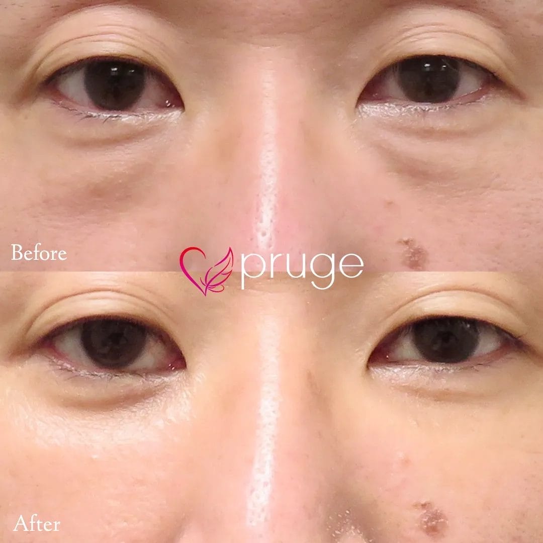 目の下のクマ・ふくらみ