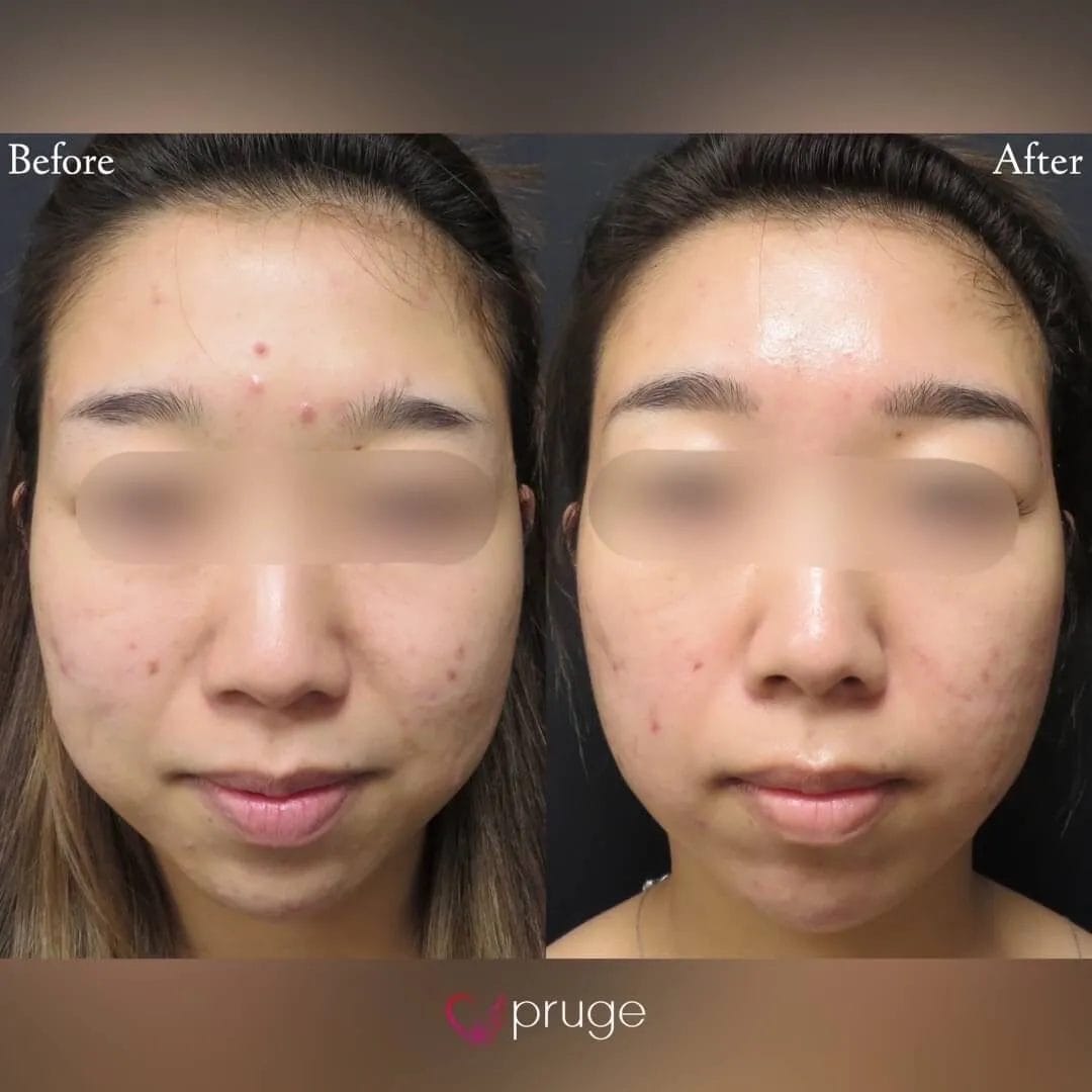 ヴァンパイアフェイシャル（全顔）