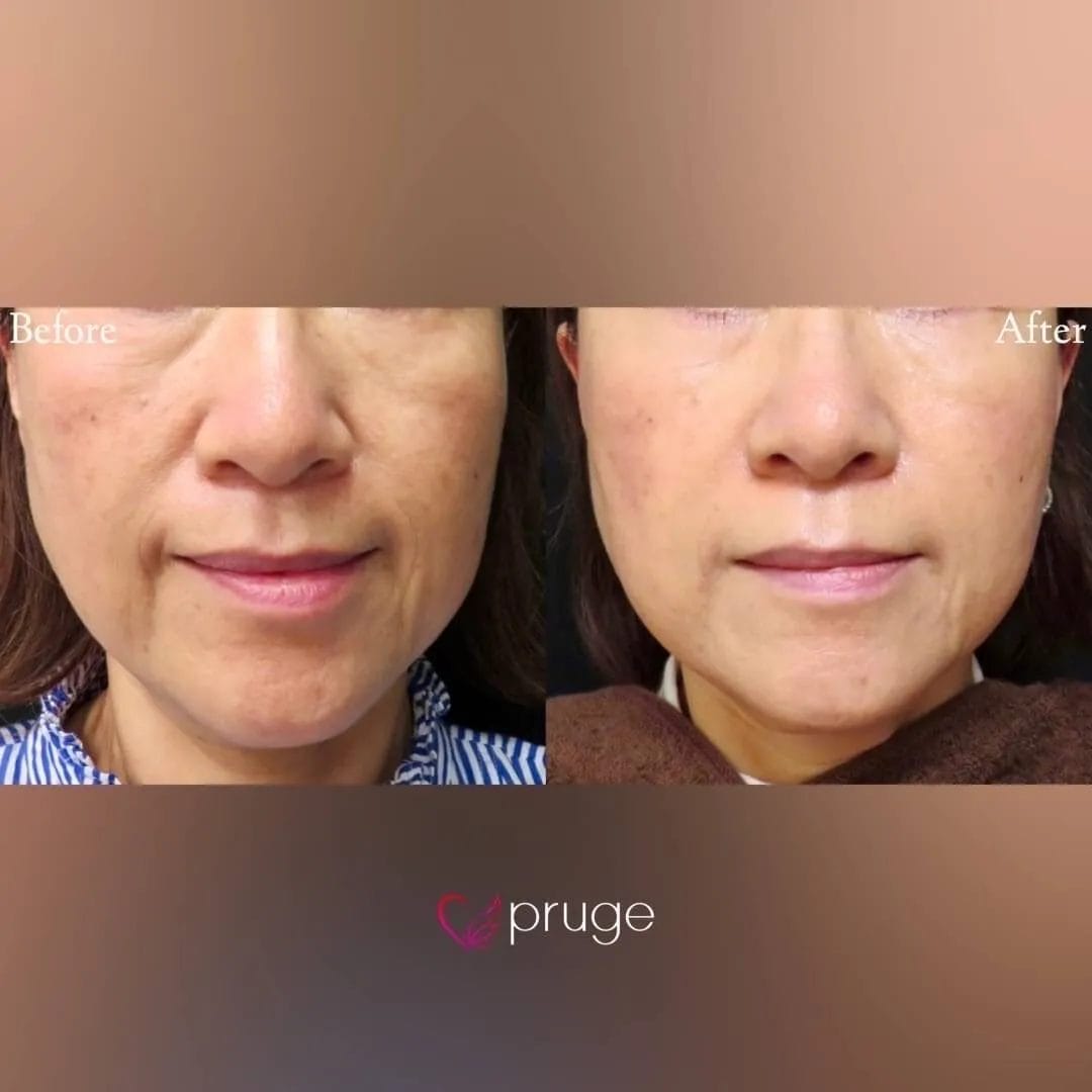 PRP注射（ほうれい線）