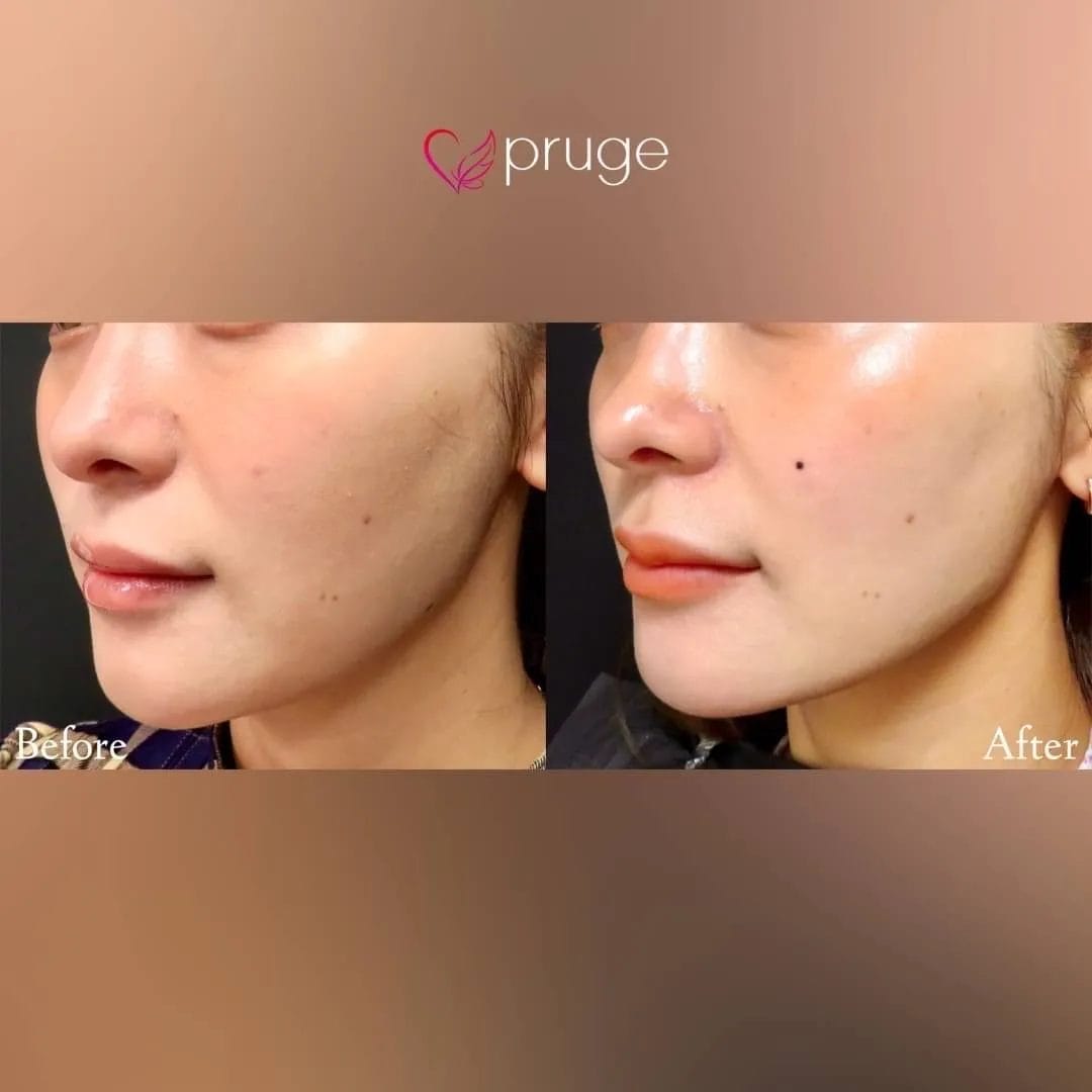 ｐスリム注射（フェイスライン）