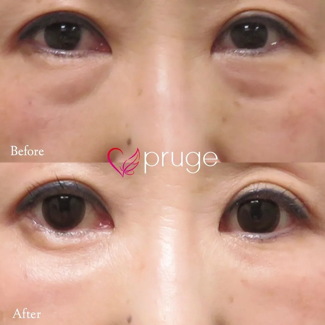 経結膜脱脂術で眼窩脂肪を取り除き、ご自身の血液から抽出したPRPを、皮下組織に注入し、組織の修復効果が得られることで、症状が改善します。