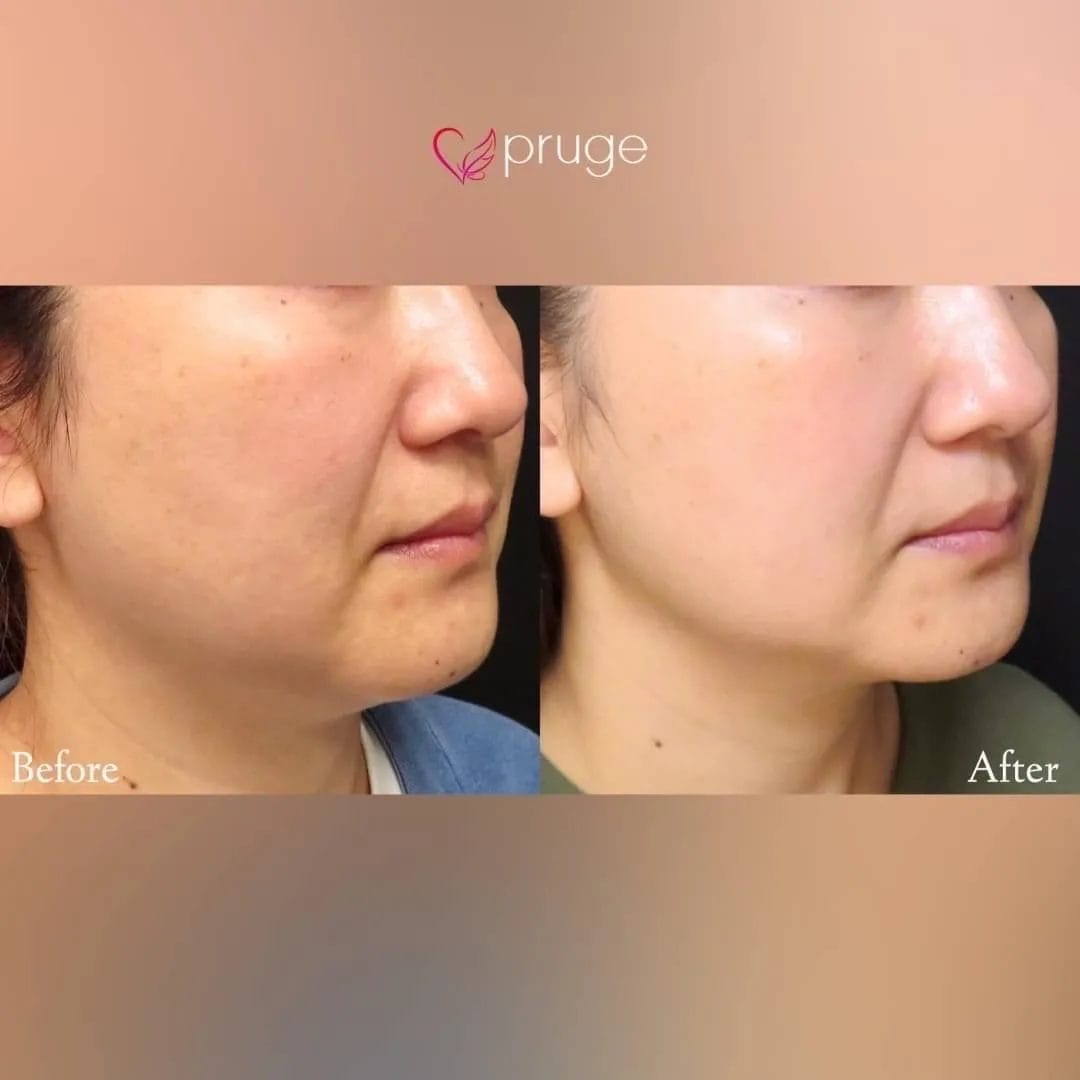 ｐスリム注射（フェイスライン・あご下）