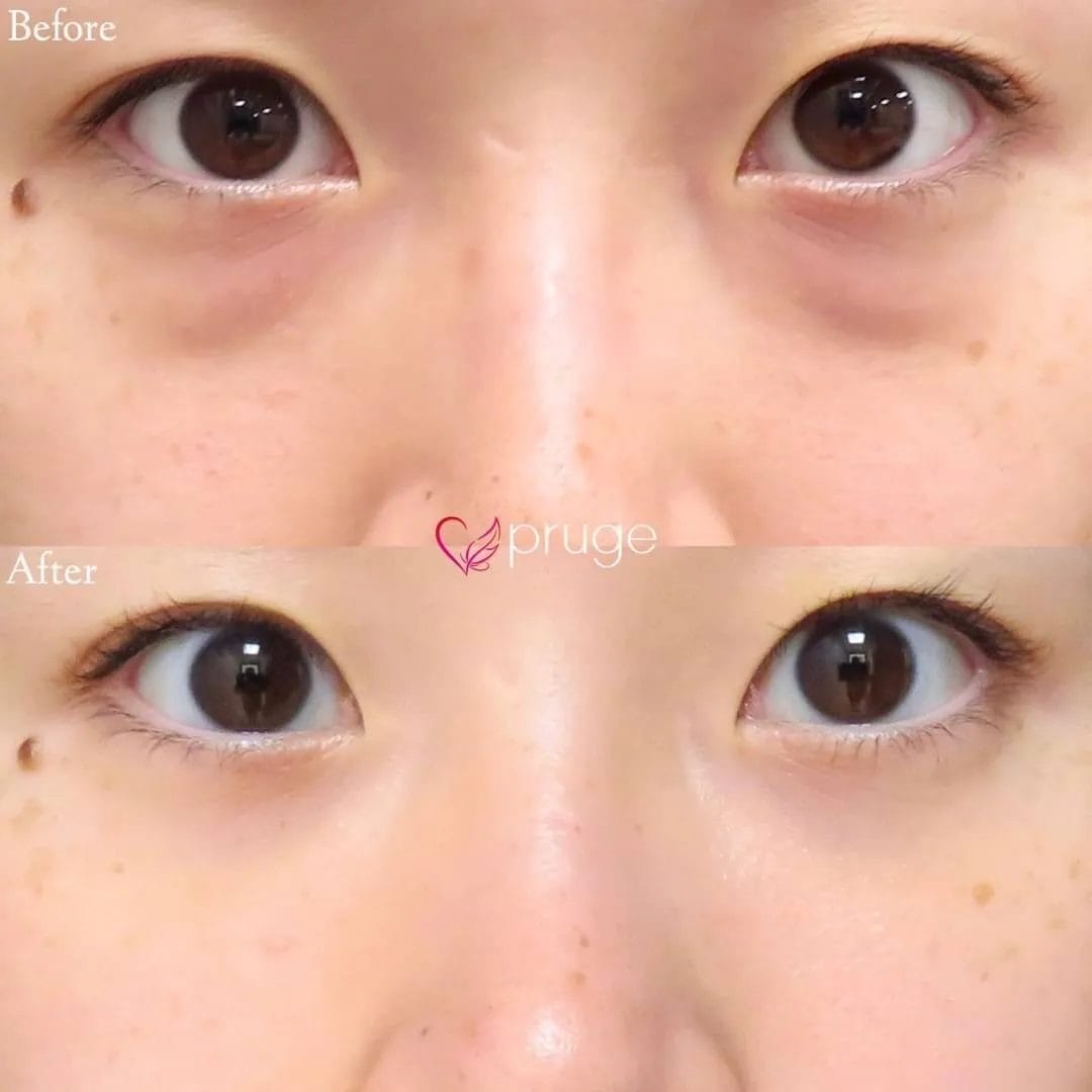 PRP-MI脱脂術（目の下）