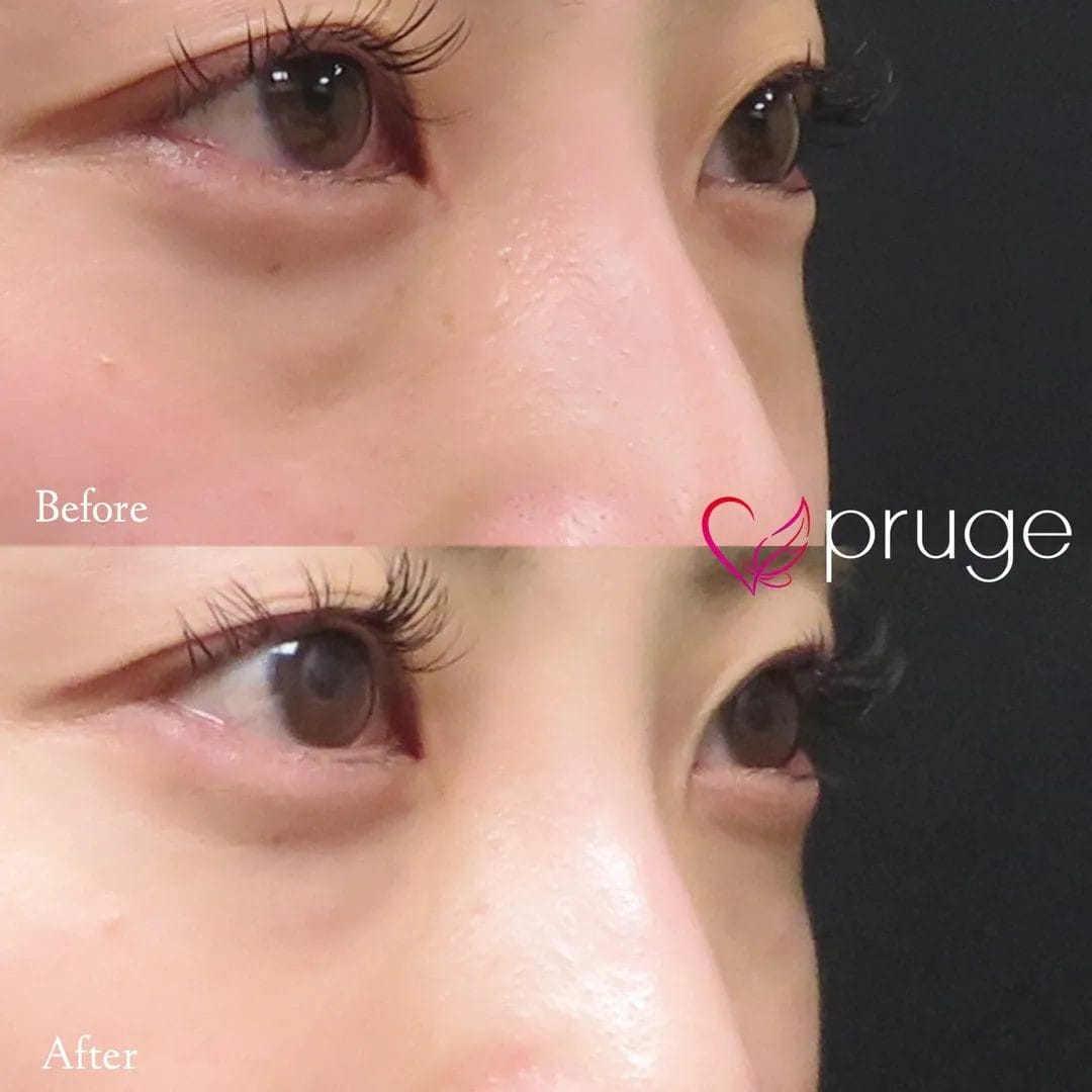 経結膜脱脂術で眼窩脂肪を取り除き、ご自身の血液から抽出したPRPを、皮下組織に注入し、組織の修復効果が得られることで、症状が改善します。