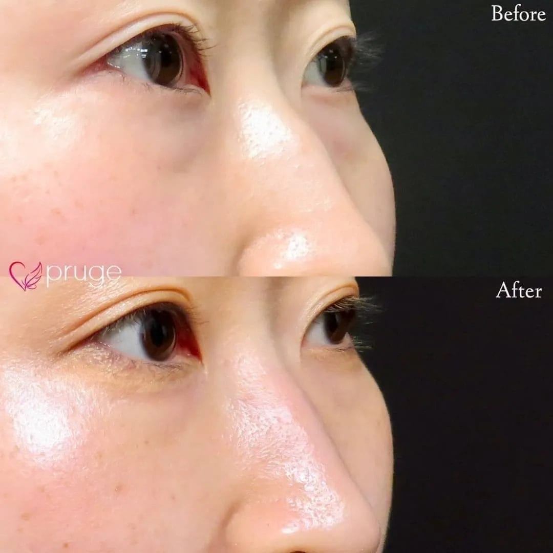 PRP-MI脱脂術アイスプレミアム（目の下）