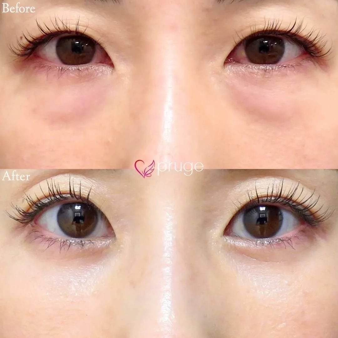 お写真の患者様は、目の下の膨らみ・クマに加え、余分な脂肪が下瞼を押し上げ、目の開きが悪くなっておりましたが、PRP脱脂術をお受け頂き適切な量の脂肪を除去した事で、目の開きが自然に最大化！クマも改善し、パッチリ華やかなお目元になっております。