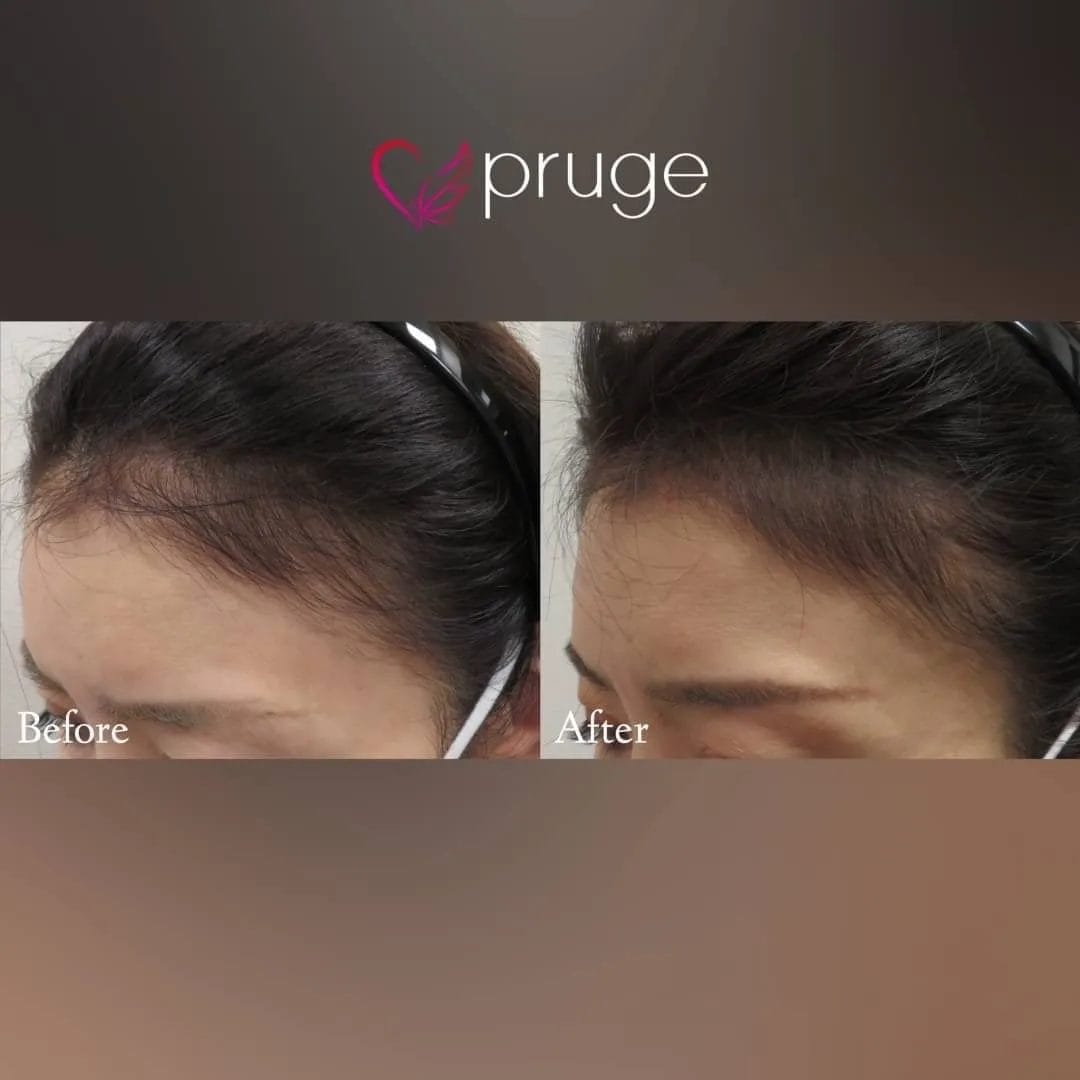 p-スカルプ（2回）