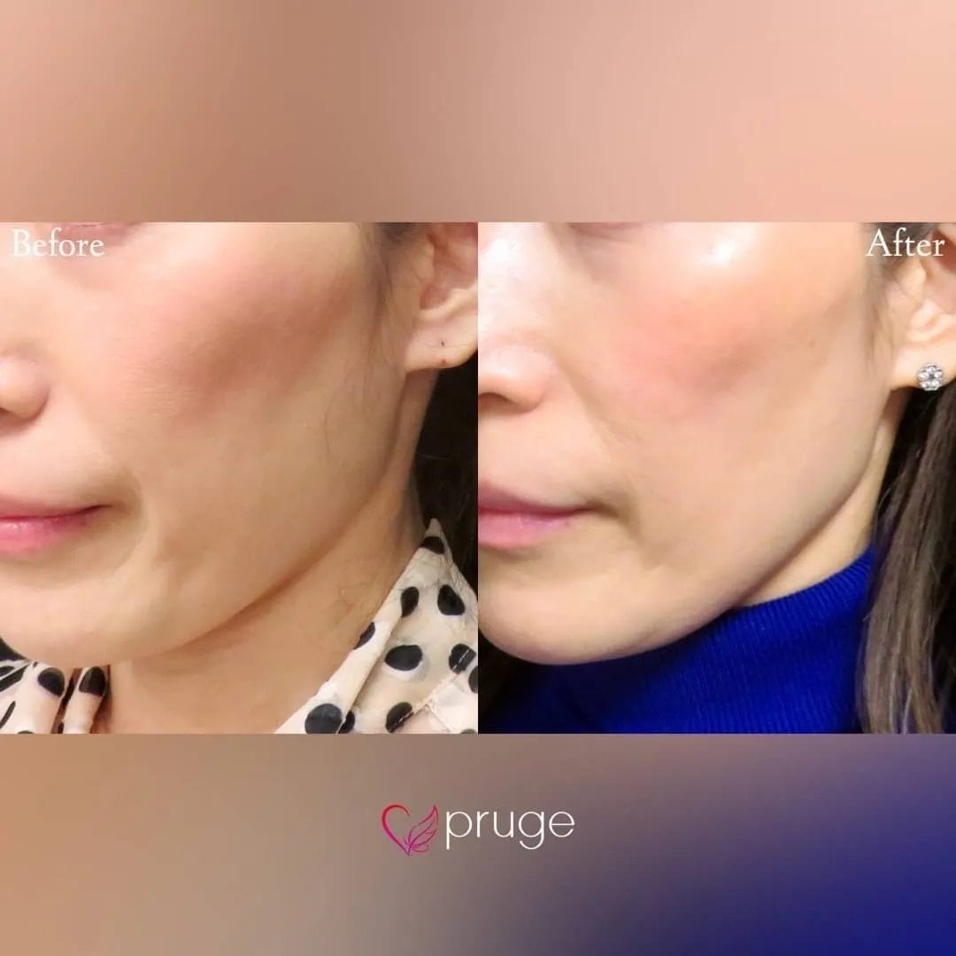 PRP注射（ホホ）