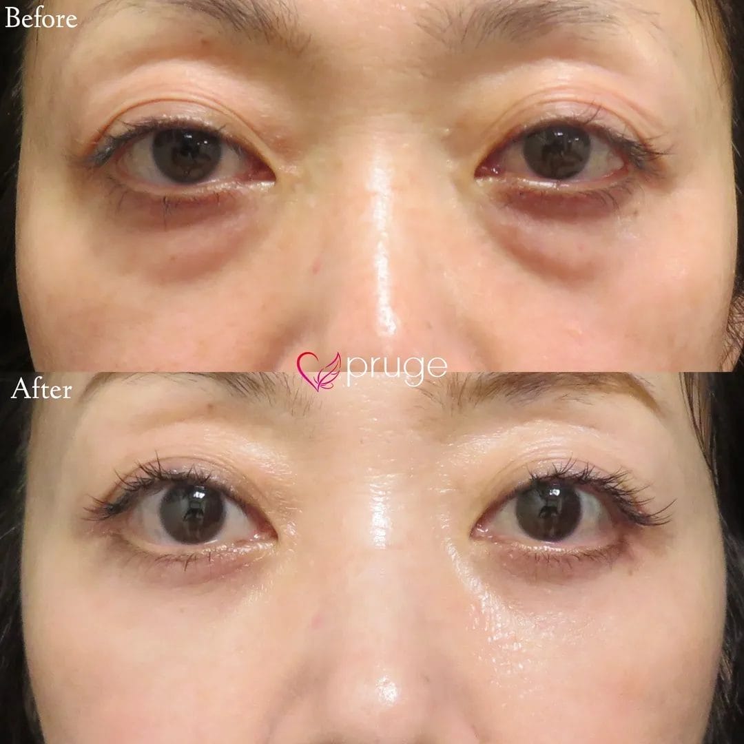 お目元が全体的に落ち窪んでいる方は、目の下のクマのみを治療しても暗い印象が残りがちです。