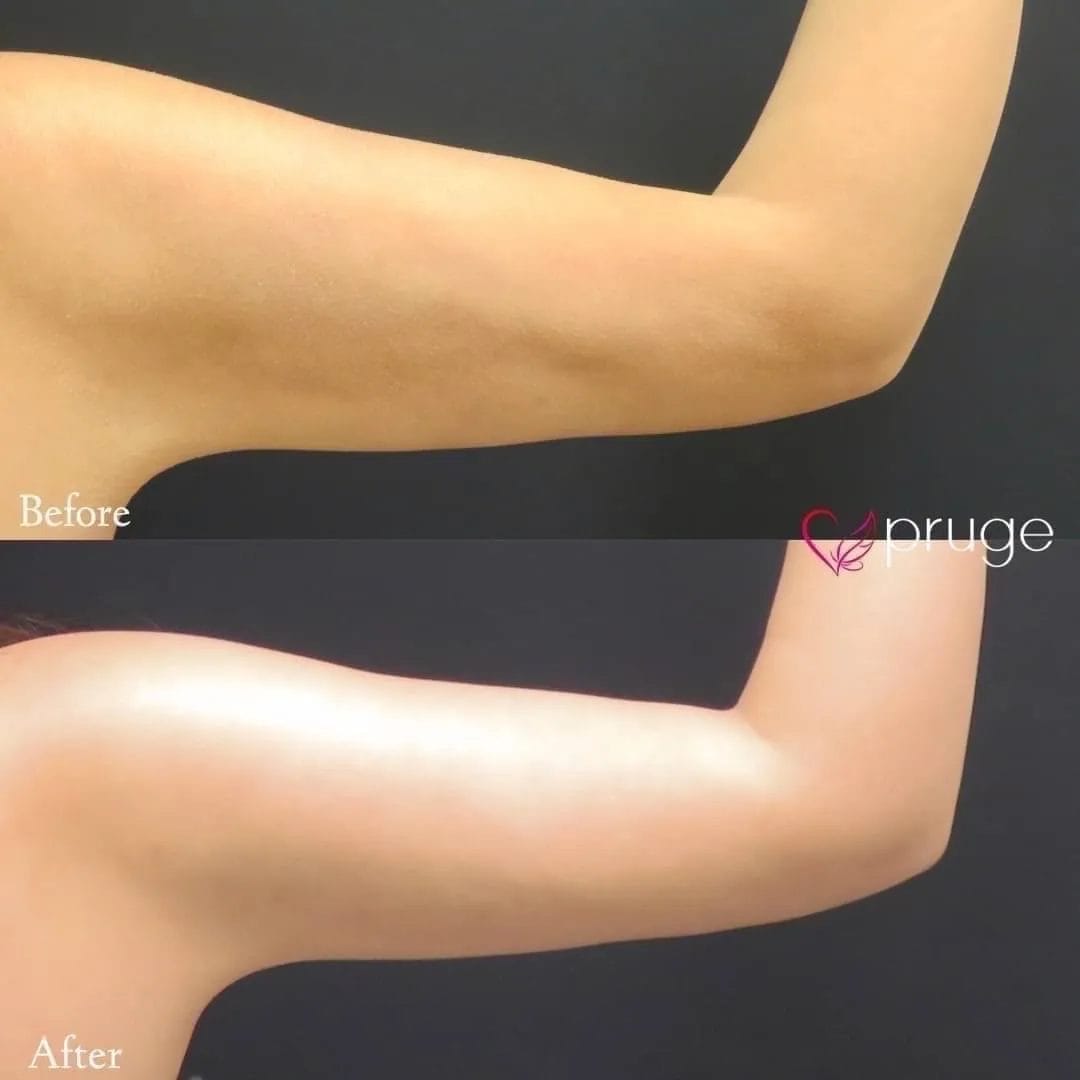 脂肪吸引後修正（二の腕）