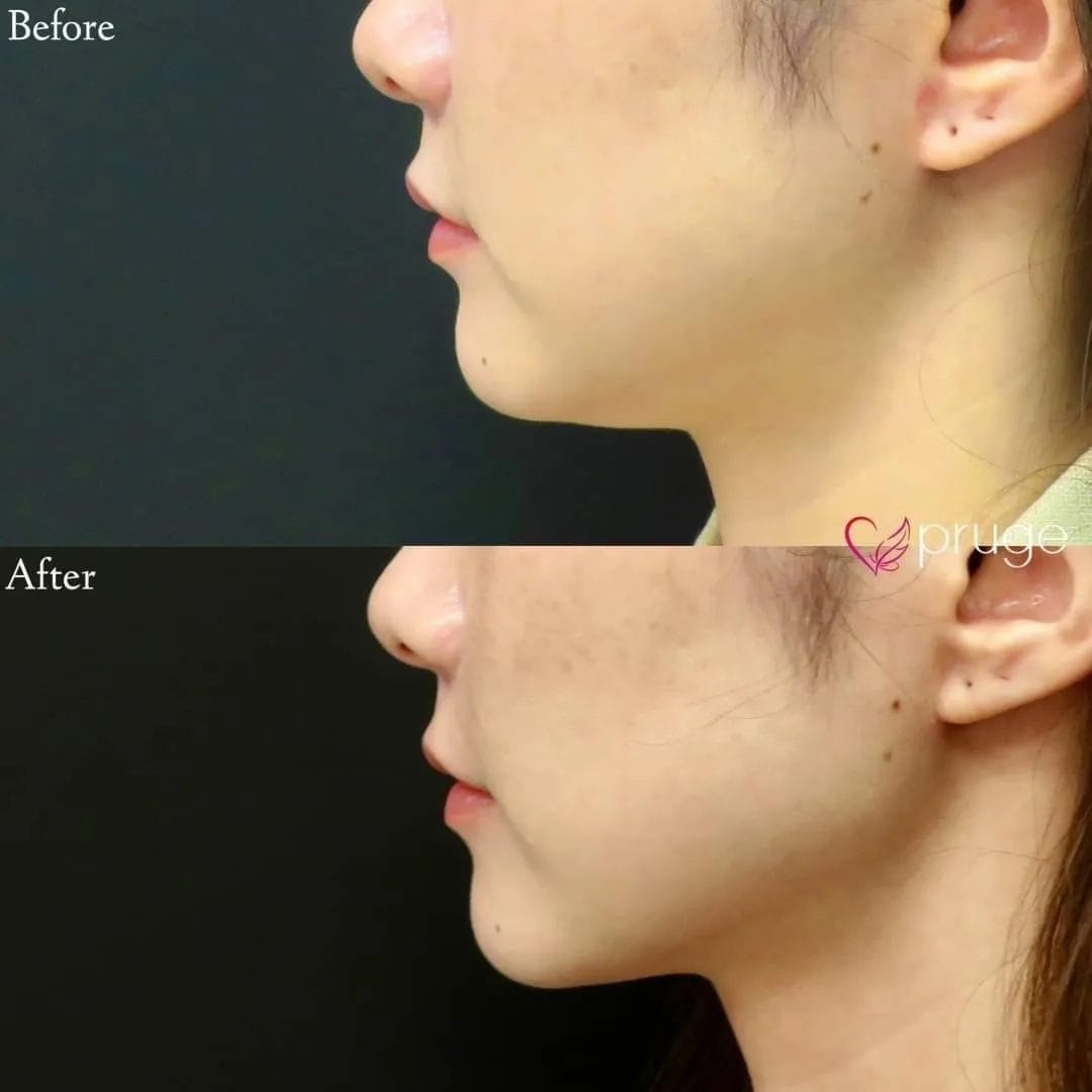 現代病のストレートネックは痩せていても二重顎の原因になるため、アゴ下の脂肪が目立つ！と幅広いご年齢の方からご相談が多くなっております。