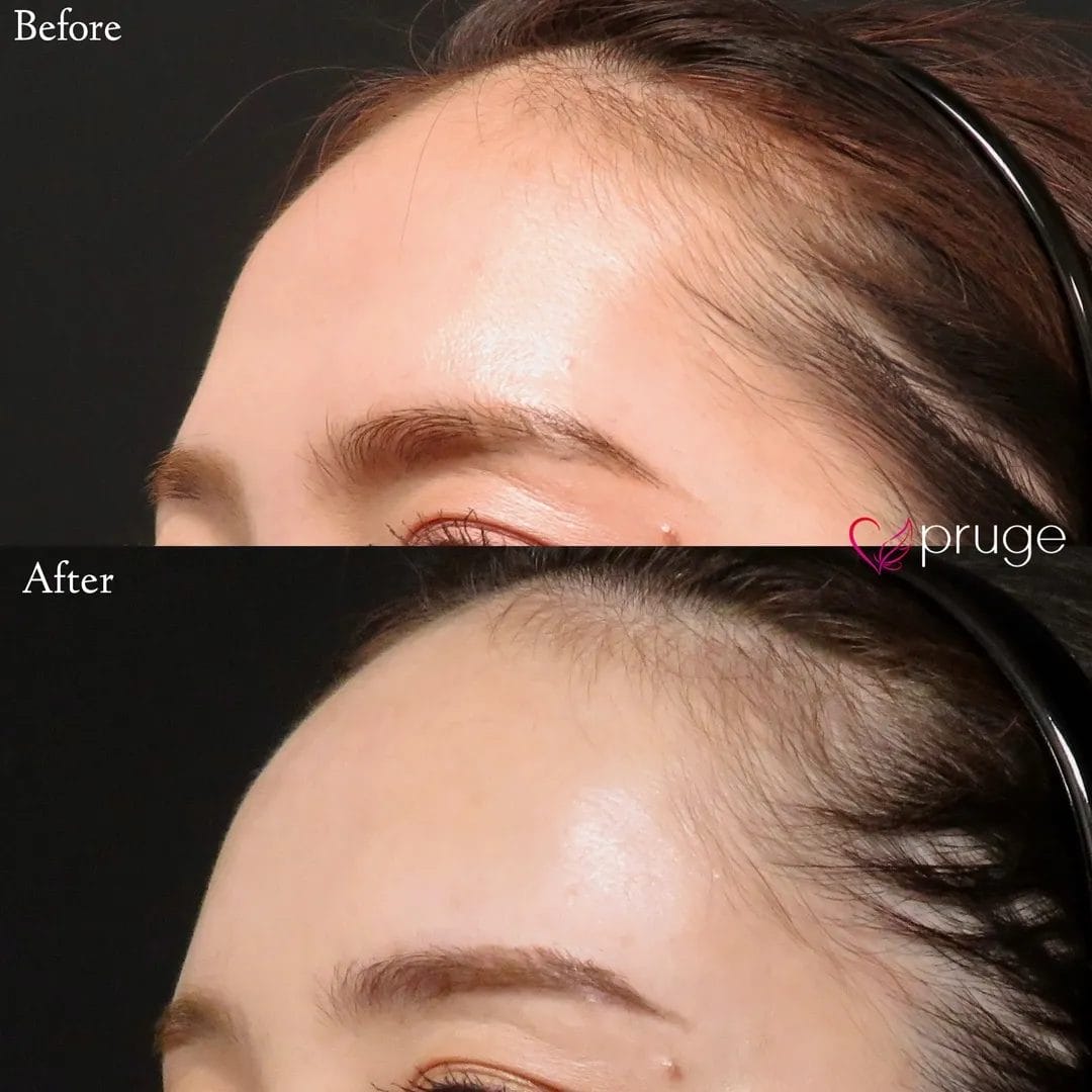 PRP注射(ひたい・こめかみ丸み形成)